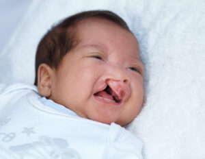 Cleft Lip & Palate Treatment Singapore