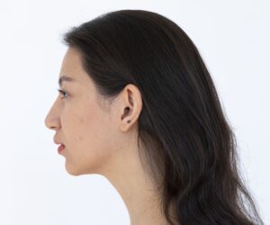 Orthognathic Surgery Singapore