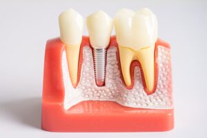 Dental Implant Aftercare Guide Singapore