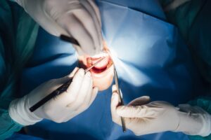Wisdom Tooth Removal Singapore