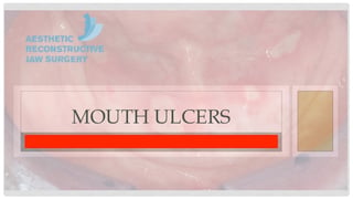Mouth Ulcers
